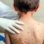 Aumentan contagios de sarampión y Puebla ocupa sexto lugar nacional